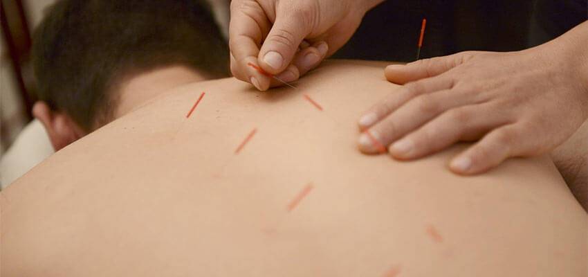 Acupuncture Back Pain Treatment