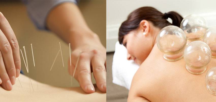 Acupuncture Cupping Therapy