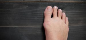 prevent bunion issue How You Can Prevent Bunions