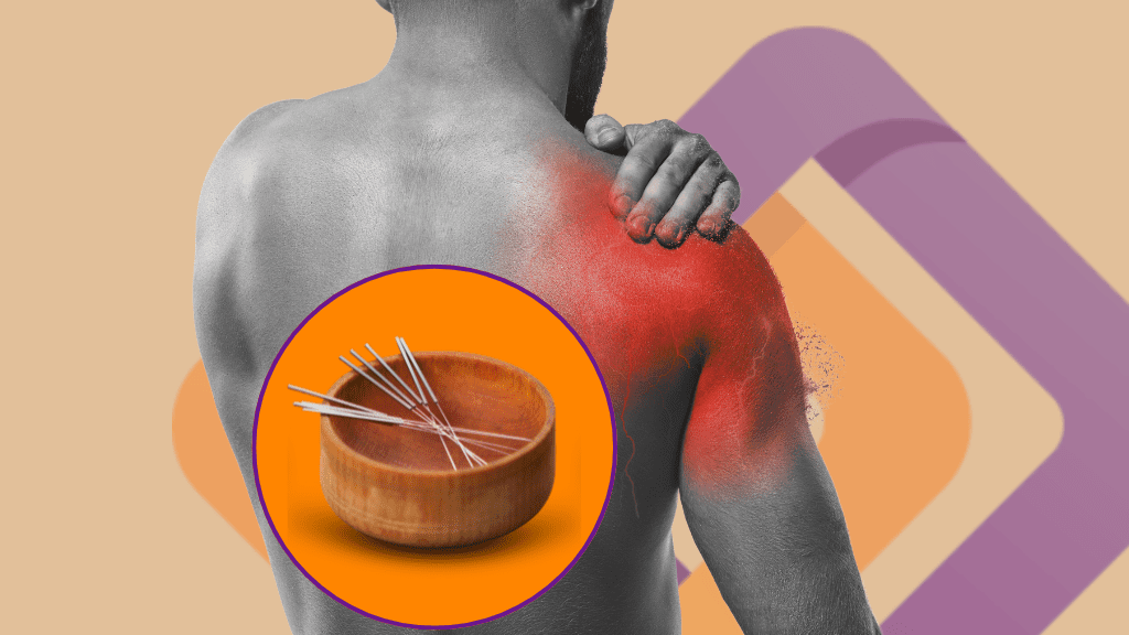 Acupuncture for Fibromyalgia