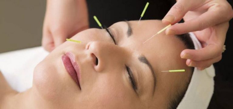 Benefits Using Acupuncture Reduce Anxiety 768x361 