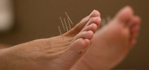 using acupuncture neuropathic pain treatment Using Diet & Acupuncture for Neuropathic Pain Treatment