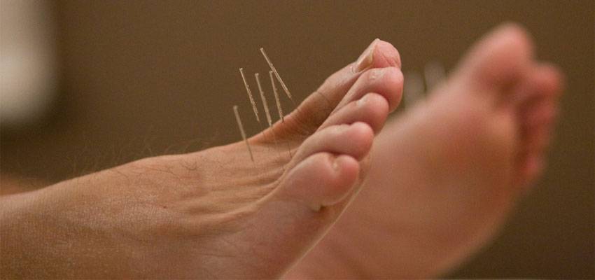 Using Acupuncture Neuropathic Pain Treatment
