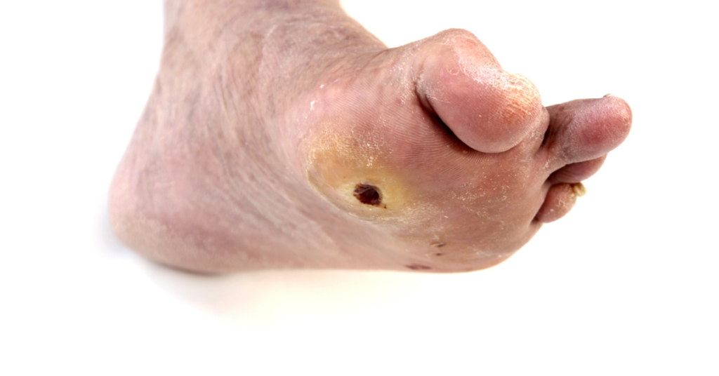 foot ulcer The Benefits of Custom Orthotics for Diabetics